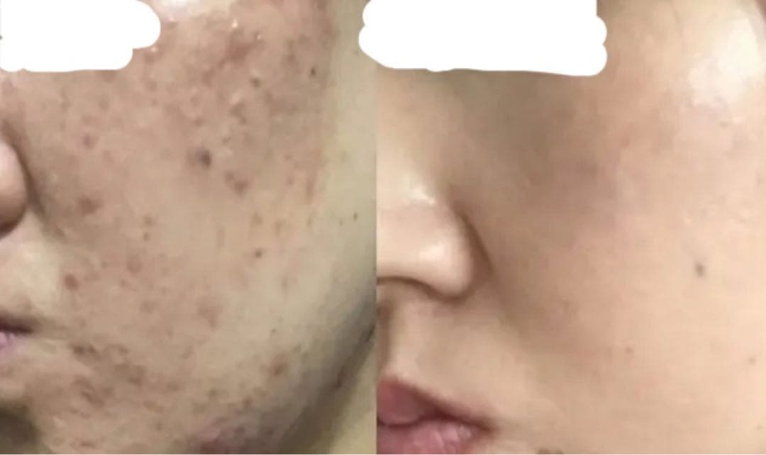 限定セット　皮むけあり　プレミアムハーブピーリング4〜8回分国産農薬不使用　超得